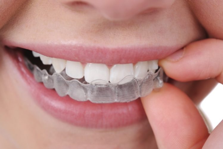 Descubre 8 de los beneficios de llevar ortodoncia invisble