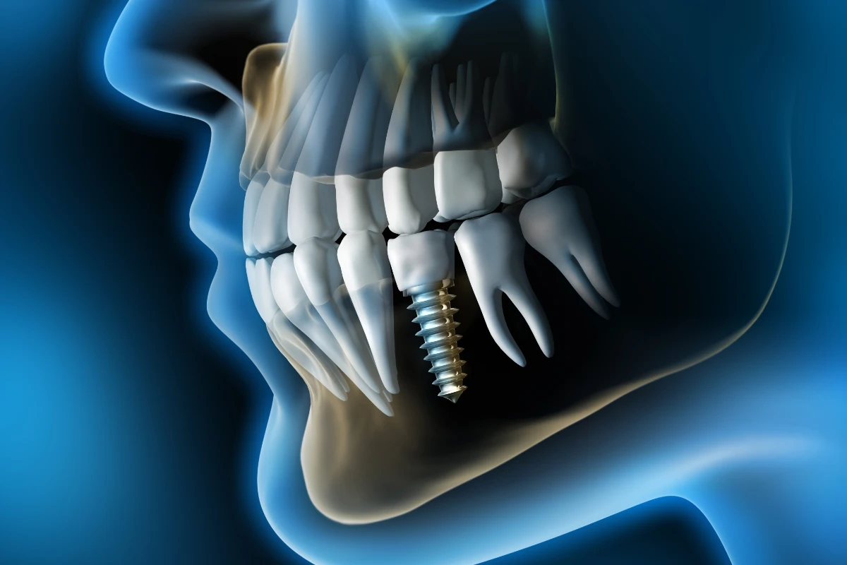 Implantes Dentales Implantologia Coi Palma