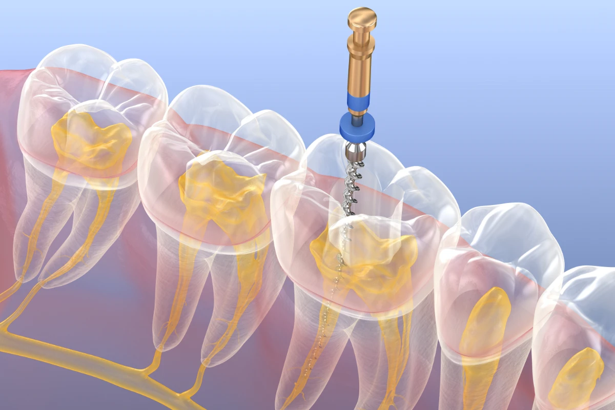 Proceso Endodoncia Coi Palma